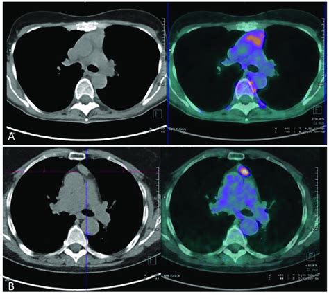 PET CT Findings In A Patient With Thymic Hyperplasia A And A