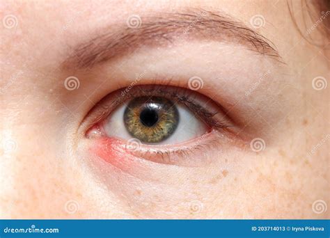 Inflammation Redness In The Lower Eyelid Chalazion Gordolum Girl`s