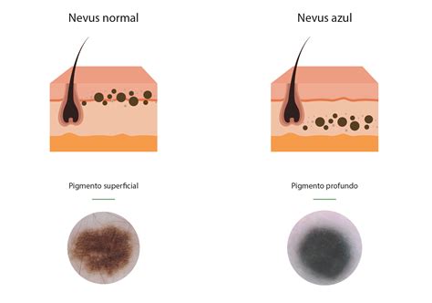 Nevus Azul ¿necesito Preocuparme Si Tengo Un Lunar Azul En La Piel