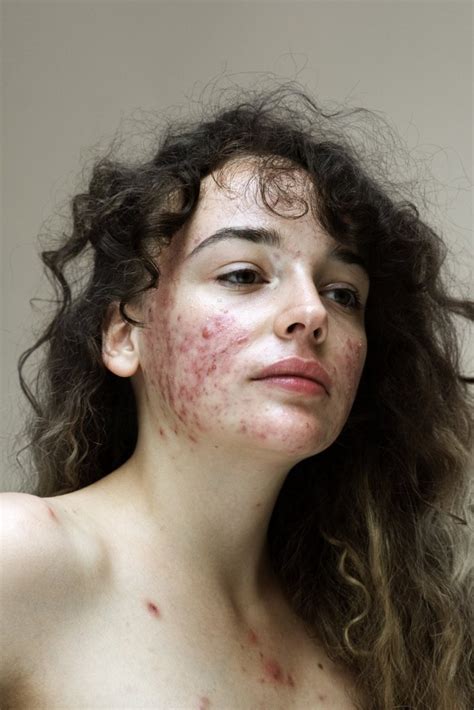Photos Help Women With Acne Break Down The Stigma Of Skin Conditions Metro News