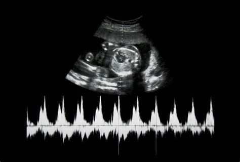 Alat ini akan digunakan selama masa kehamilan hingga saat kelahiran bayi. Detak Jantung Janin Normal