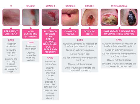 Pressure Ulcer Staging Chart Stages Of Pressure Injuries Pressure Ulcer
