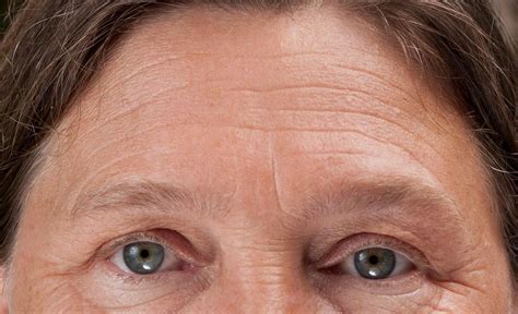 How To Remove Forehead Lines And Creases Quickly And Naturally