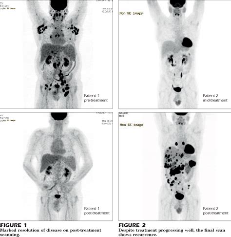 Figure 2 From The Use Of Petct In Hodgkin S Lymphoma Semantic Scholar