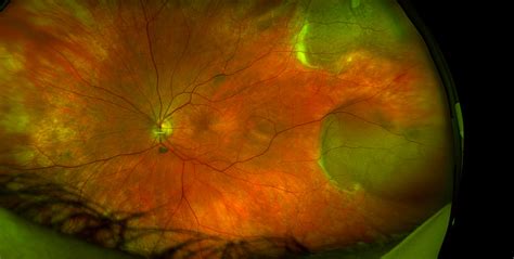 Svetlana pilyugina, a retina specialist at assil eye institute of los angeles, discusses retinal tears: Optomap Retinal Exam - Thomas Vision Clinic of Leesville, LA