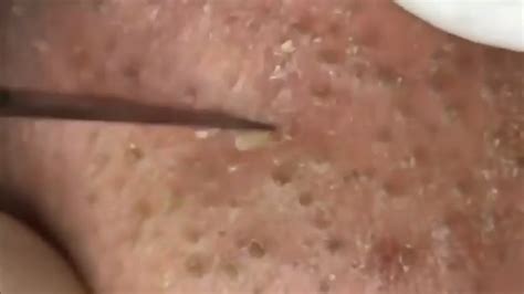Best manual blackhead remover tool. massive blackhead removal from nose - YouTube