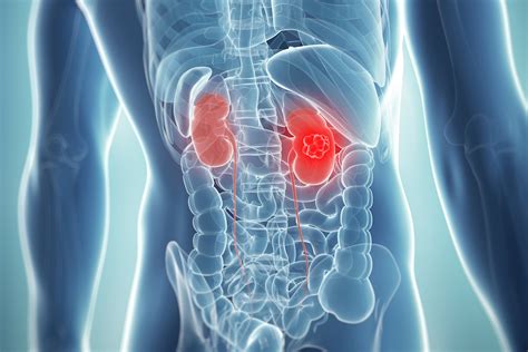 Unfortunately, it's also one of the hardest to detect, and most of the time kidney cancer doesn't cause any symptoms until the tumor has grown. Kidney Cancer Signs, Symptoms, Causes, Treatments