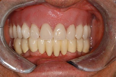 Cost Full Mouth Dental Implants I Want To Replace My Denture