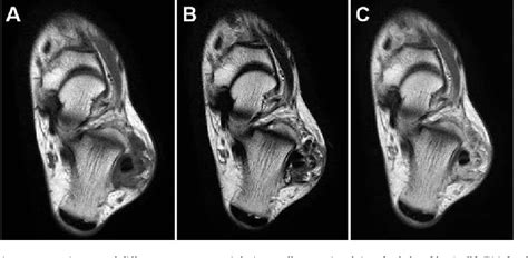 Figure 1 From Diffuse Type Tenosynovial Giant Cell Tumor With T117