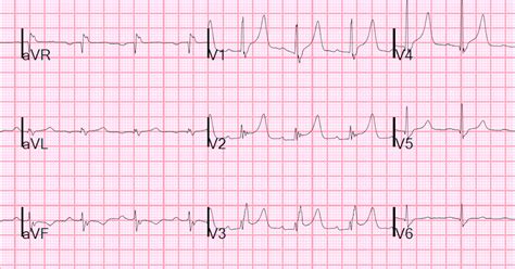 Dr Smiths Ecg Blog Nonspecific Symptoms With Rbbb And New St