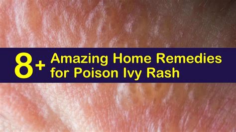 8 Amazing Home Remedies For Poison Ivy Rash