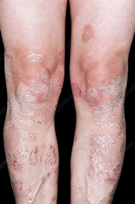 Plaque Psoriasis On The Legs Stock Image C0117477 Science Photo