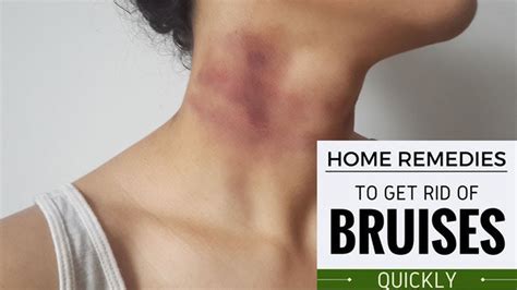 How To Get Rid Of A Bruise Quickly Dreamopportunity25