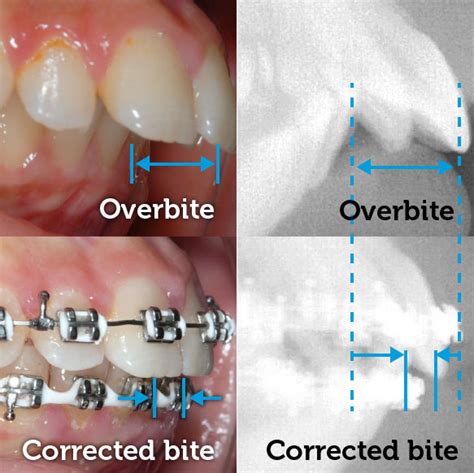 Overbite Corrected With Braces · Smile Logic Orthodontics · South