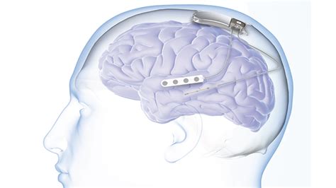 Neurostimulation System Maker Neuropace Files To Go Public Mobihealthnews