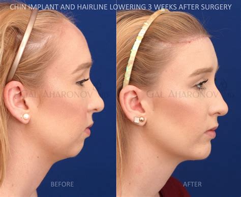 Hairline Lowering Surgery Before And After Alfred Rogers Coiffure