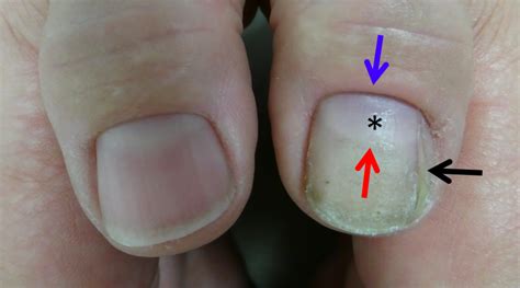 Top 142 Traumatic Avulsion Of Nail Plate Architectures Eric