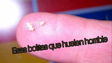 C Mo Quitar Esas Bolitas Que Salen De La Garganta C Seum O Tonsilolitos Youtube