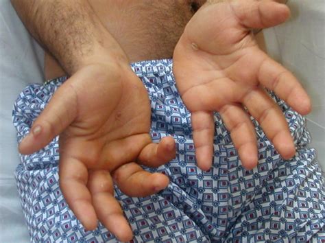 Reactive Arthritis Causes Symptoms Rash Treatment