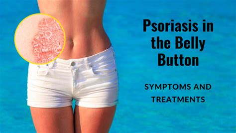 Psoriasis In Belly Button Symptoms And Treatments Hanna Sillitoe