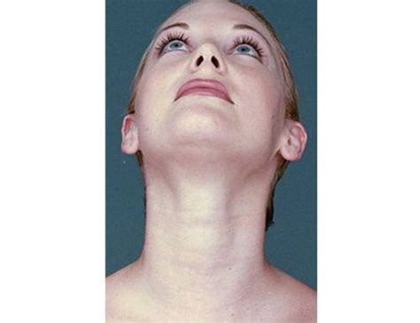Facial Exercises To Avoid Or Get Rid Of Double Chin