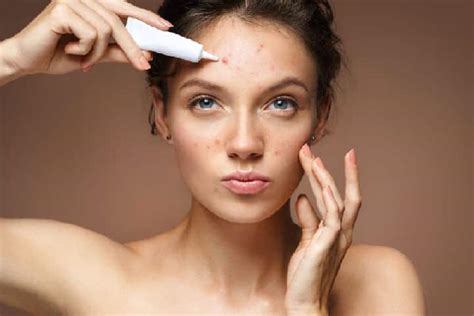 Acne Face 4 Amazing Ways To Win The War Against It