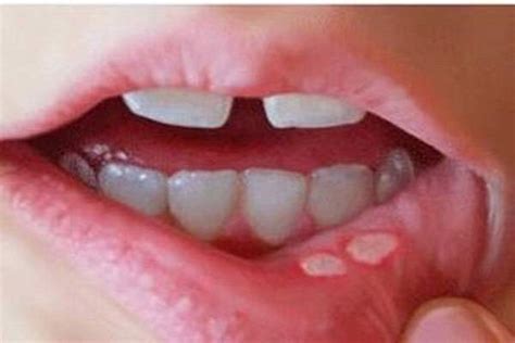 Canker Sores In Mouth Here Is How To Naturally Get Rid Of Them A