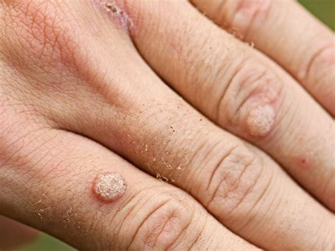 73 Images Of Viral Warts For Free Myweb