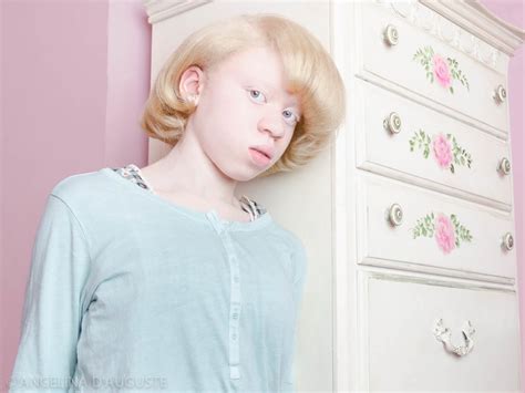 Albinism Photographs POPSUGAR Beauty Photo