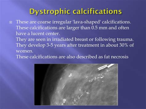 Ppt Breast Calcifications Differential Diagnosis And Birads