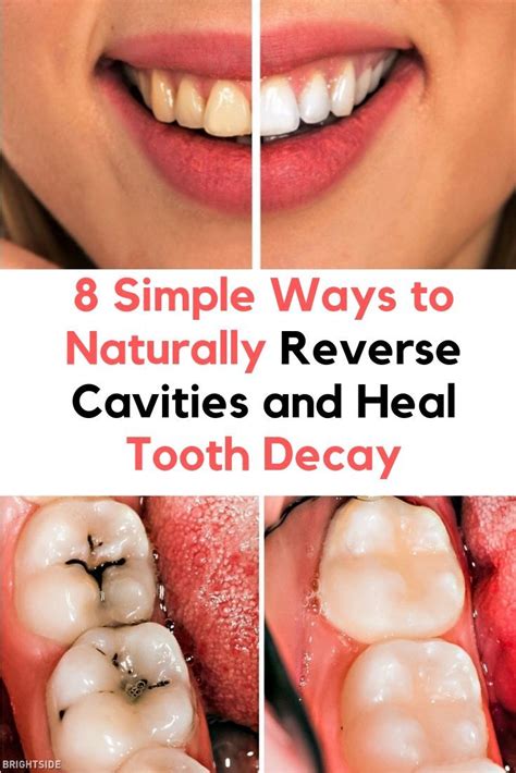 8 Simple Ways To Naturally Reverse Cavities And Heal Tooth Decay Heal Cavities Reverse