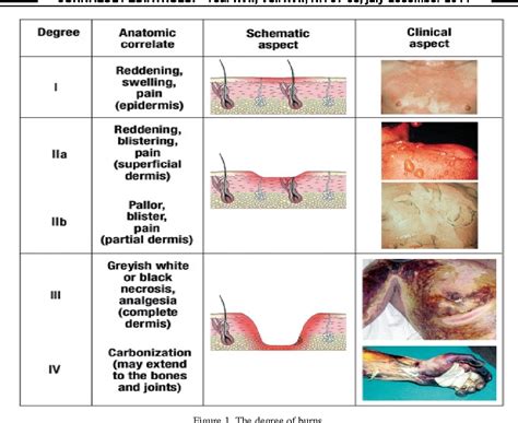 Figure 2 From Pediatric Burns And Scalds Modern Therapeutic Concepts