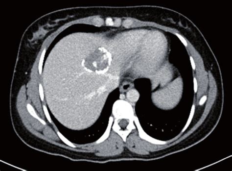 Contrast Enhanced Abdominal Computed Tomography Showing And Hydatid