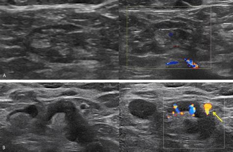 A Normal Axillary Lymph Node In A 62 Year Old Female Patient On