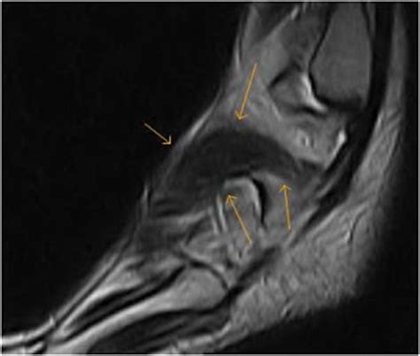 Mri and ultrasound have been utilised in the assessment of the plantar intrinsic foot muscles. Accessory foot muscle-MRI - Sumer's Radiology Blog