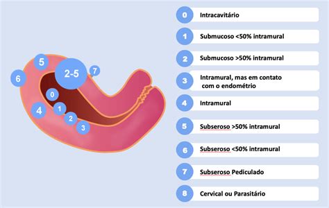 Miomas Uterinos Leiomioma e a Classificação FIGO MUSA