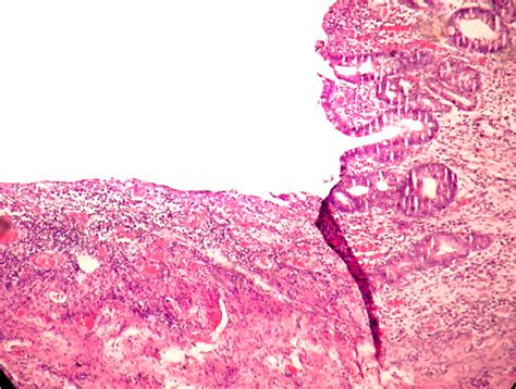 Figure 6 Histology Of The Resected Jejunal Segment Ulcerated Mucosa