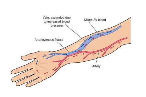 Arterio Venous Fistula How To Look After It Healthtips By TeleMe
