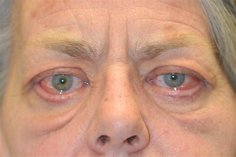 Thyroid Eye Disease Presenting Symptoms