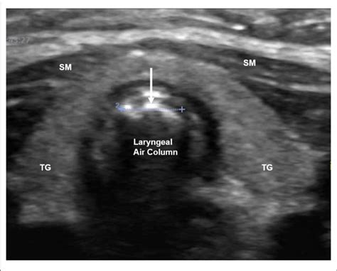 Airway Ultrasound Image At The Level Of Thyroid Gland Demonstrating