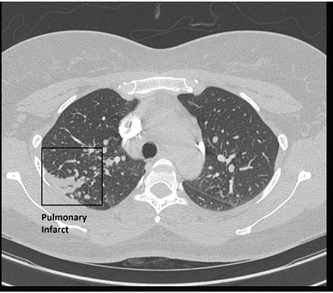 Sarcoidosis Presenting As A Case Of Pulmonary Thrombotic Disease An