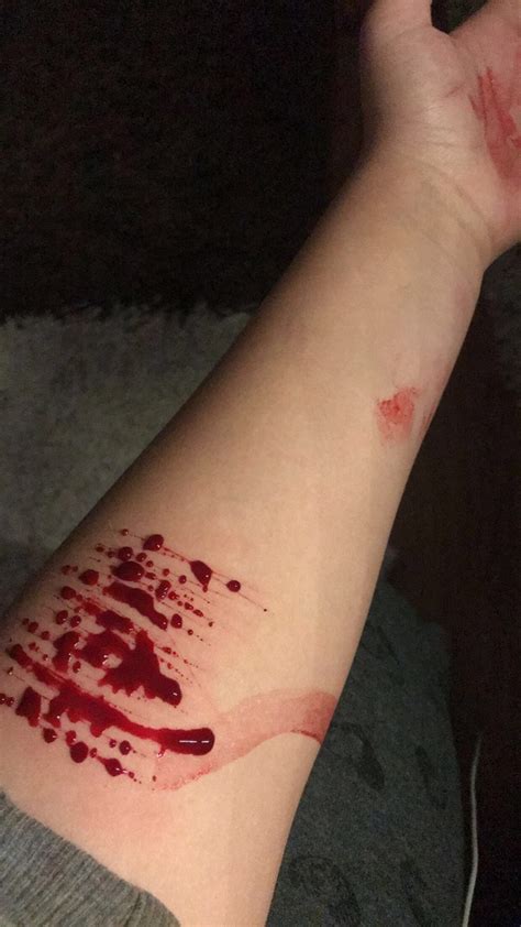 One common method is cutting with a sharp object. What is your self-harm story? Why did you begin doing it ...