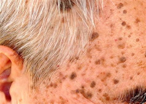Appearance Of Seborrheic Keratosis Or Age Spots In Older Adults My XXX Hot Girl