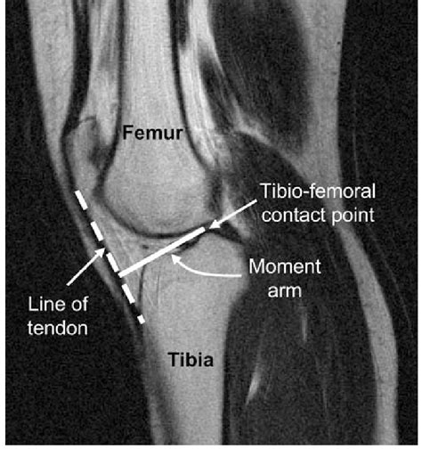 Sagittal Mri Scan Of The Knee Showing The Measurement Of The Moment Arm
