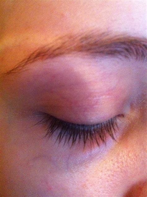 Permanent red veins in eyes. MissFitMakeup: How To Get Rid Of Under Eye Bags/Veins!