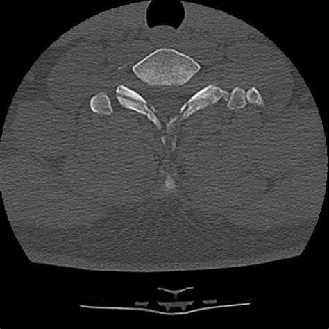 Filenormal Trauma Chest Pelvis And Spine Imaging Radiopaedia 31535