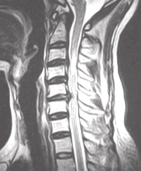 Mri Cervical Spine Sagittal Section Showing Disc Prolapse At C5 6 Level