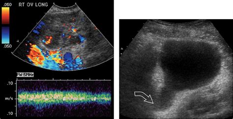 The Add Ed Fallopian Tube Torsion