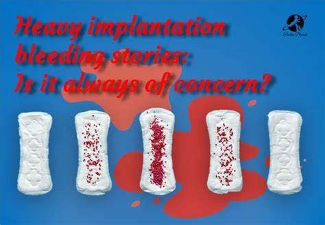 Heavy Implantation Bleeding Stories Is It Always Of Concern