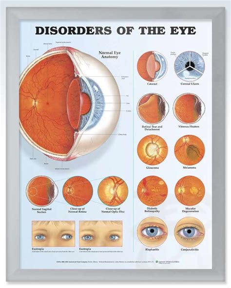 Disorders Of The Eye Exam Room Anatomy Posters Clinicalposters